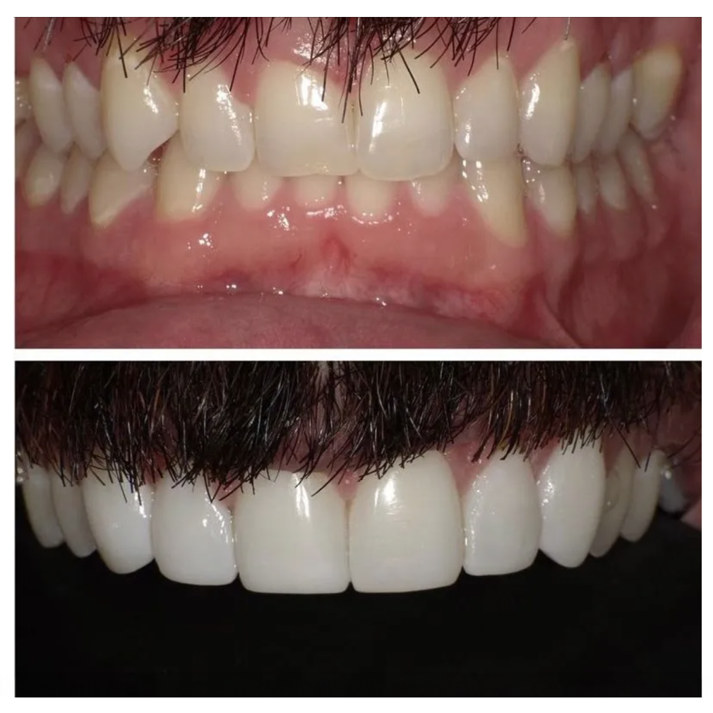 A before and after picture of a man 's teeth