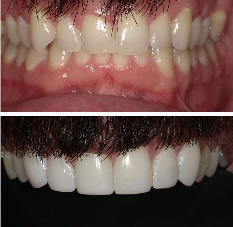 A before and after picture of a man 's teeth