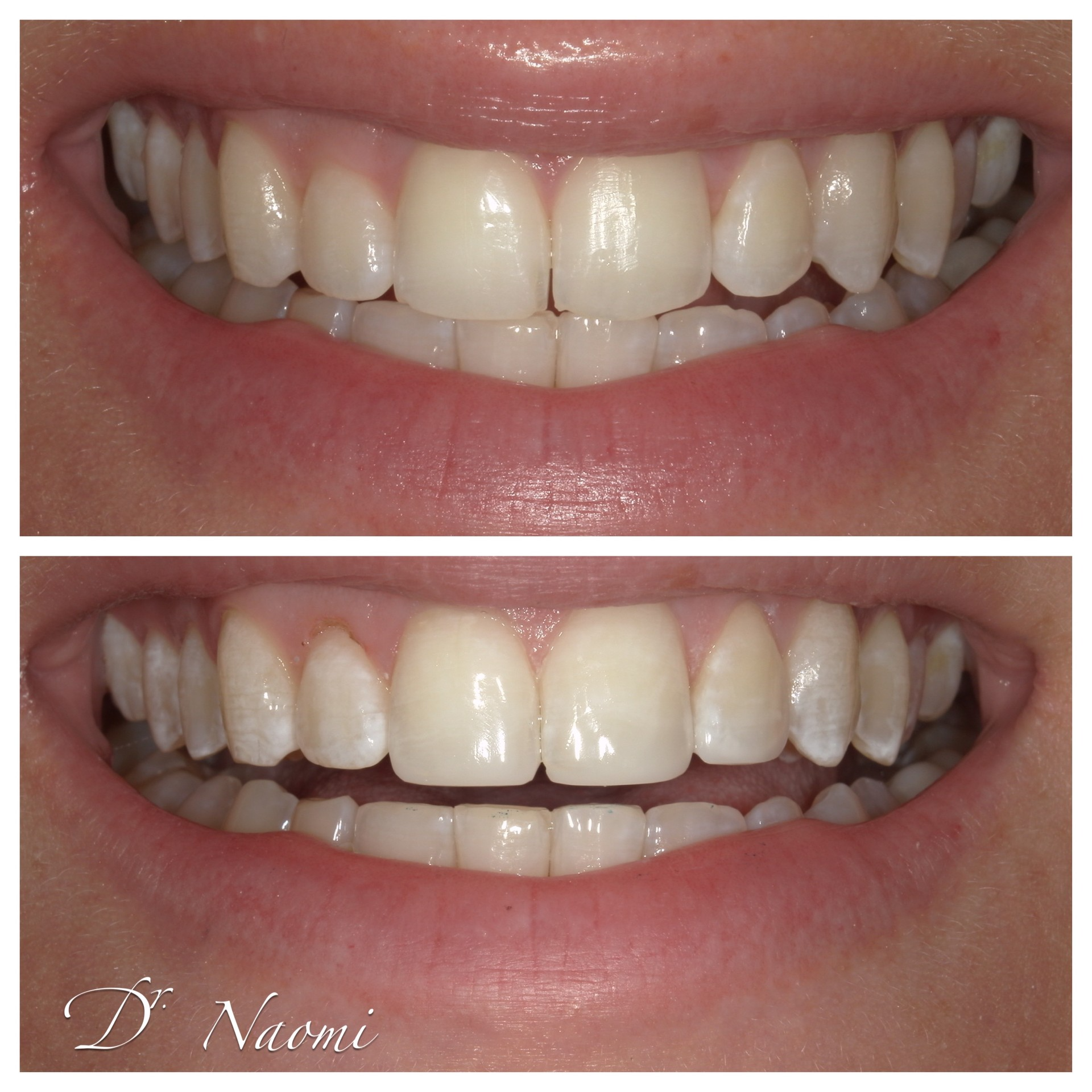 A before and after photo of a woman 's teeth by dr naomi