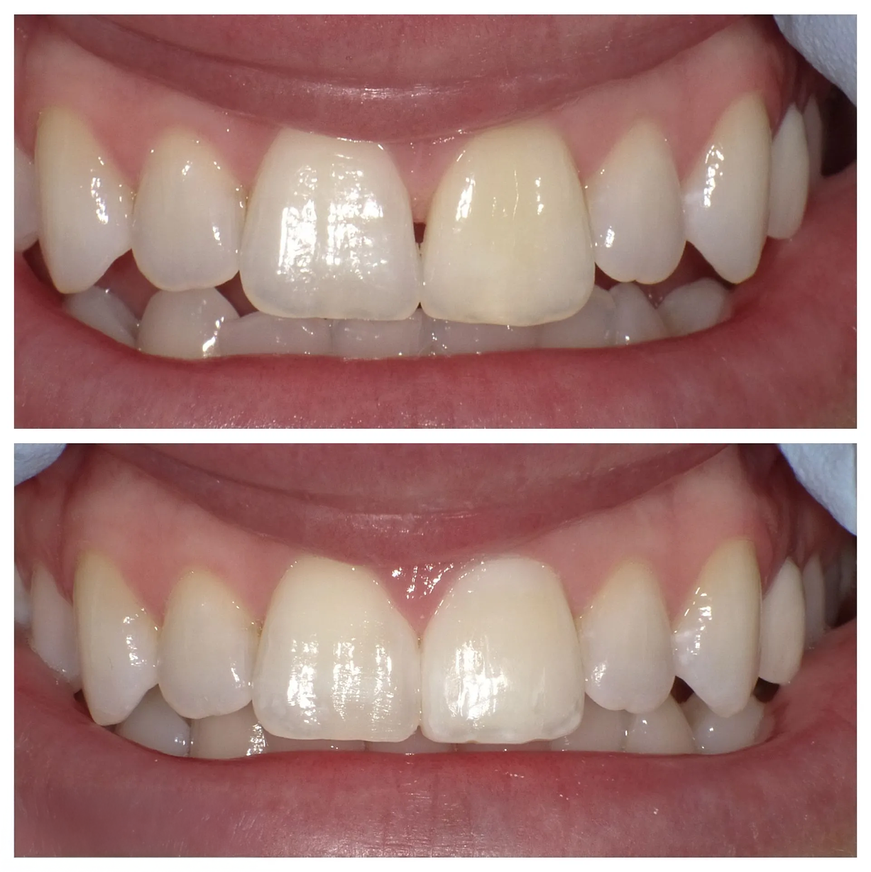 A before and after picture of a person 's teeth.