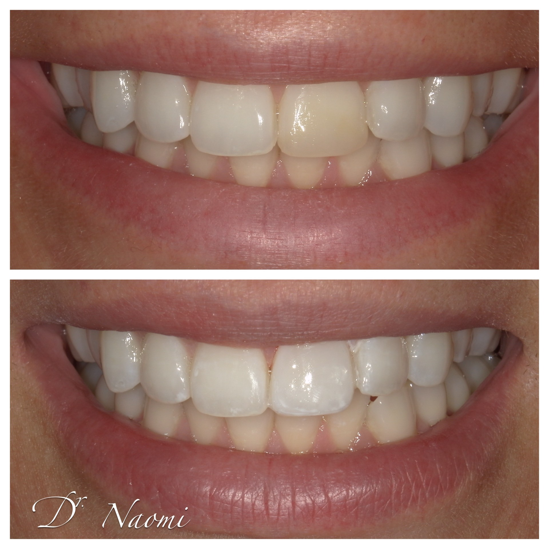A before and after photo of a woman 's teeth by dr naomi
