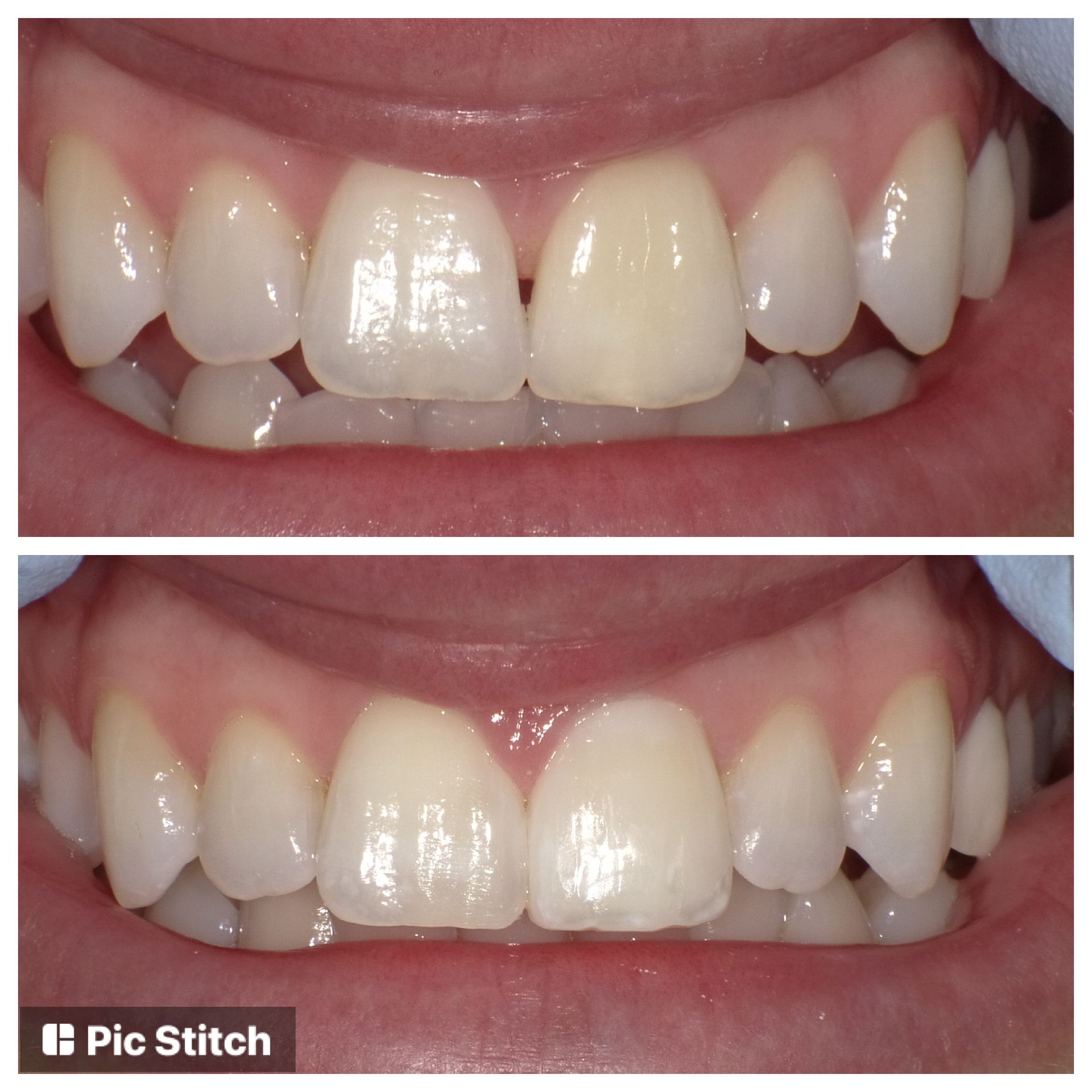 A before and after picture of a person 's teeth.