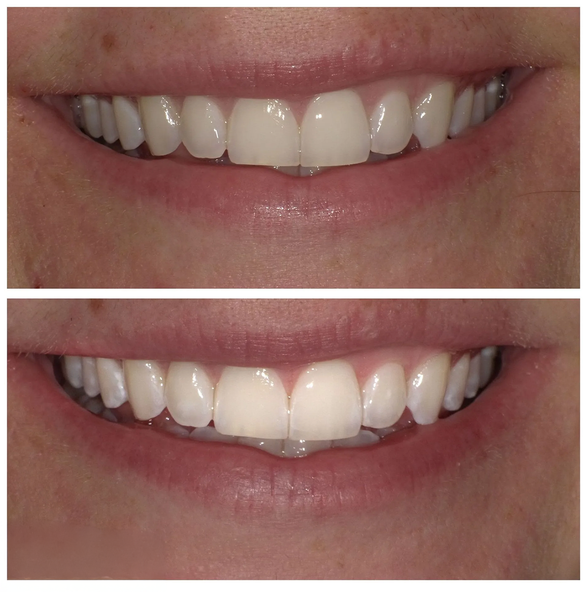 A before and after picture of a person 's teeth