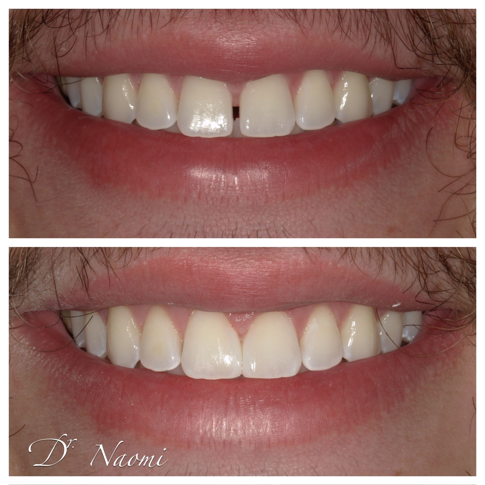 A before and after photo of a person 's teeth by dr naomi