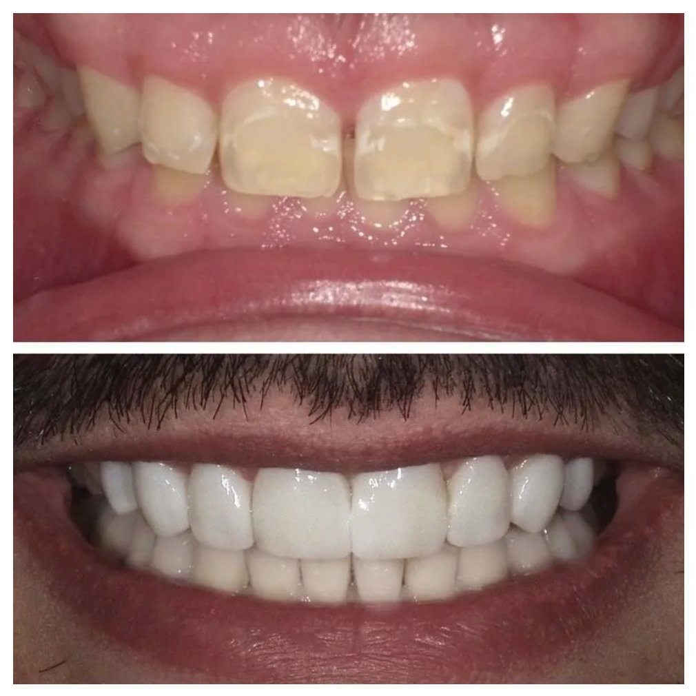 A before and after picture of a man 's teeth