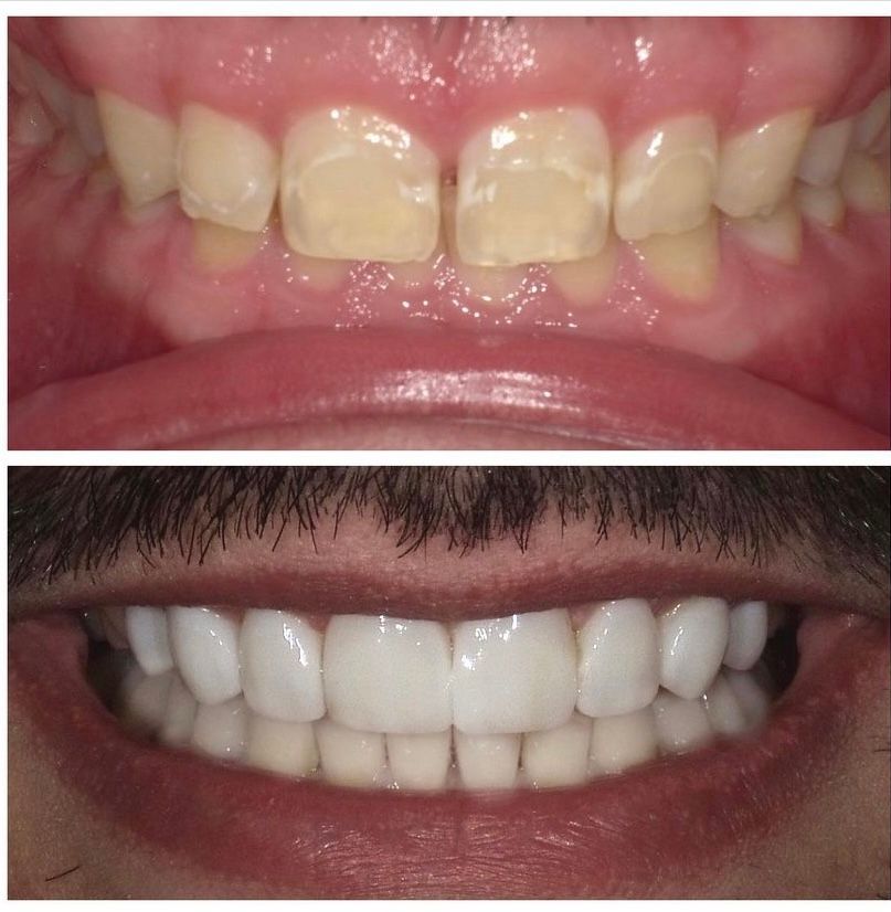 A before and after picture of a man 's teeth