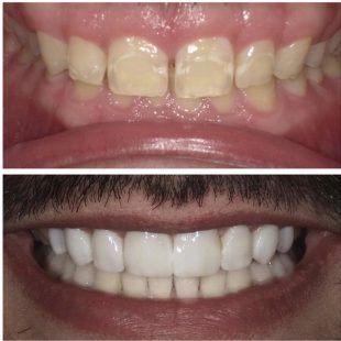 A before and after picture of a man 's teeth.