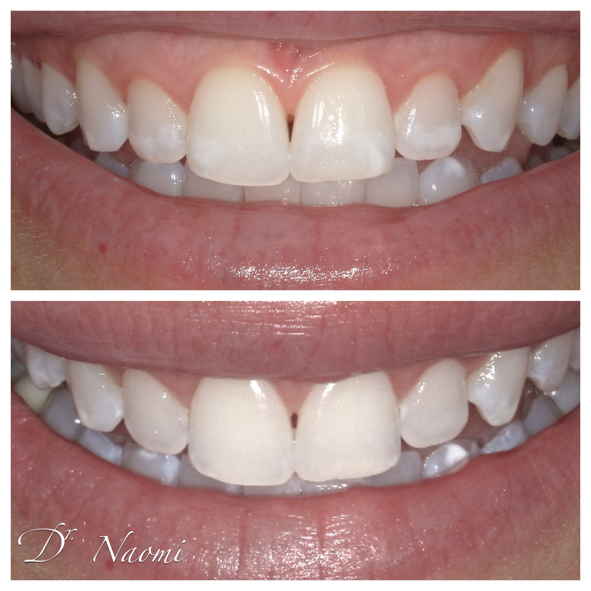 A before and after photo of a person 's teeth by dr naomi