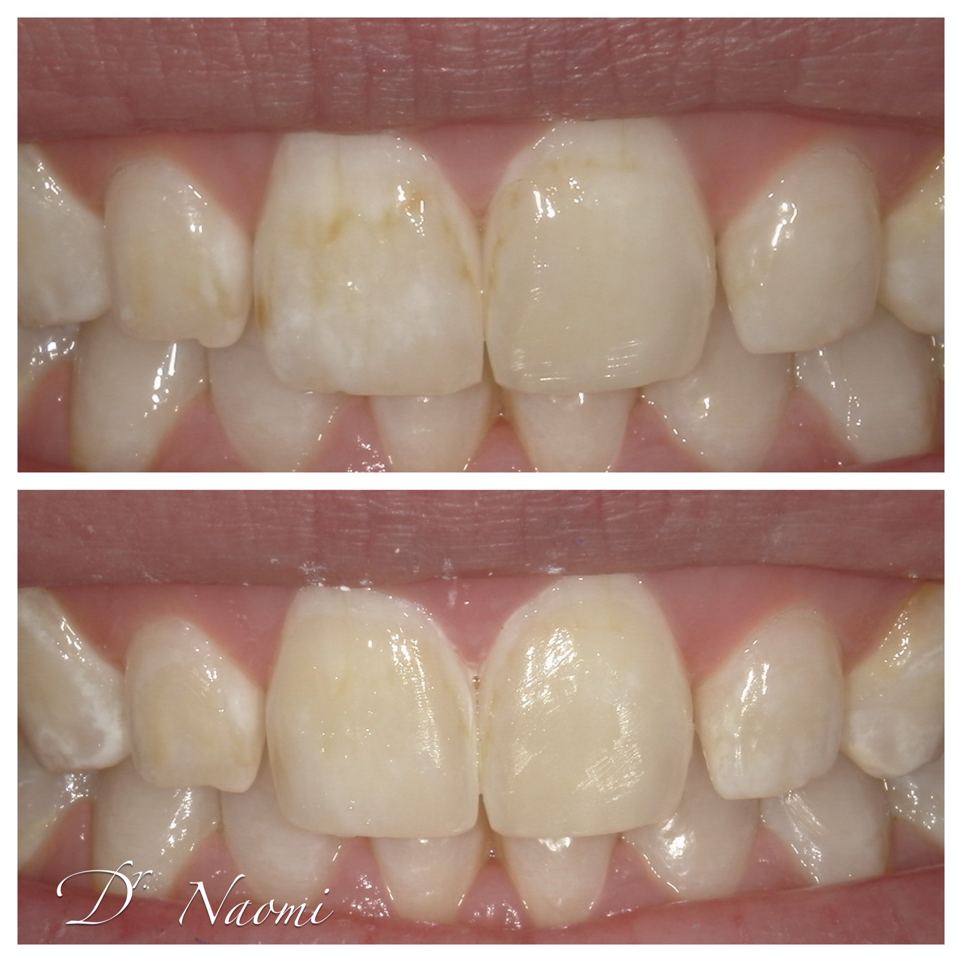 A before and after photo of a person 's teeth by dr naomi