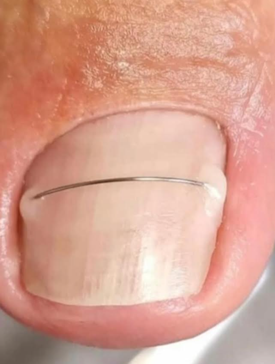 Titanium draad?
Titaniumdraad is nuttig bij de behandeling van eeltige nagels. Als deze draad enigszins uitzet, helpt hij ontstekingen van de nagelrollers te genezen en corrigeert hij de vervorming van de nagels.
Deze behandelmethode is uitgevonden en met succes toegepast door Zwitserse podotherapeuten. De behandelmethode is volledig pijnloos. De titaniumdraad op de nagel wordt meestal twee weken tot een paar maanden gedragen.
Deze methode is echt effectief, dus als je nagelproblemen hebt, neem dan gerust contact met mij op! Ik beloof dat het geen pijn zal doen, je levenskwaliteit niet zal verstoren, en dat het resultaat zelf aan al je verwachtingen zal voldoen en de vorm van je nagel zal verfraaien tot een gezonde positie.