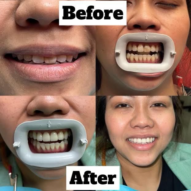 Dental Zone-Cleburne-Texas-Teeth Whitening- Before and After