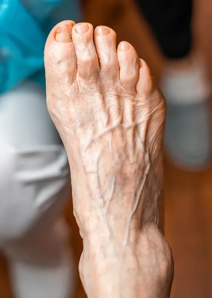 Top-down view of a light-skinned foot, showing prominent veins and wrinkles.