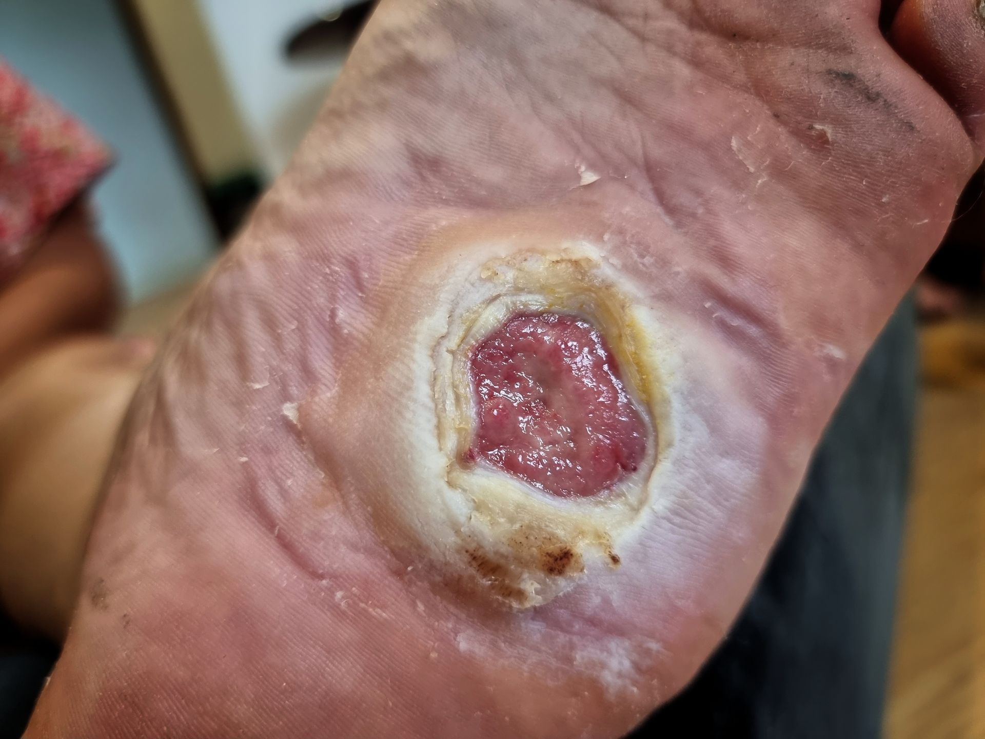Foot with an open, circular ulcer on the sole; exposed tissue surrounded by raised, discolored skin.