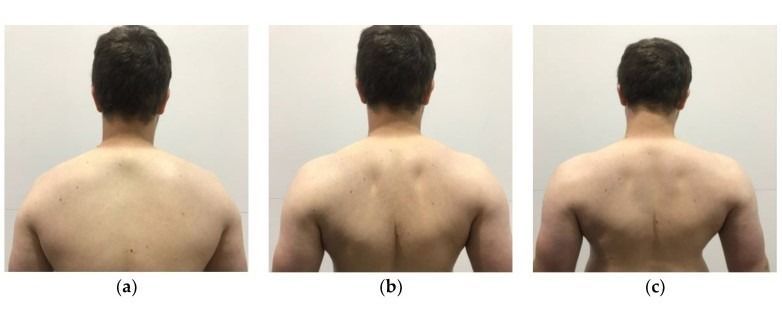 Scapular rotation exercises for Thoracic Outlet Syndrome