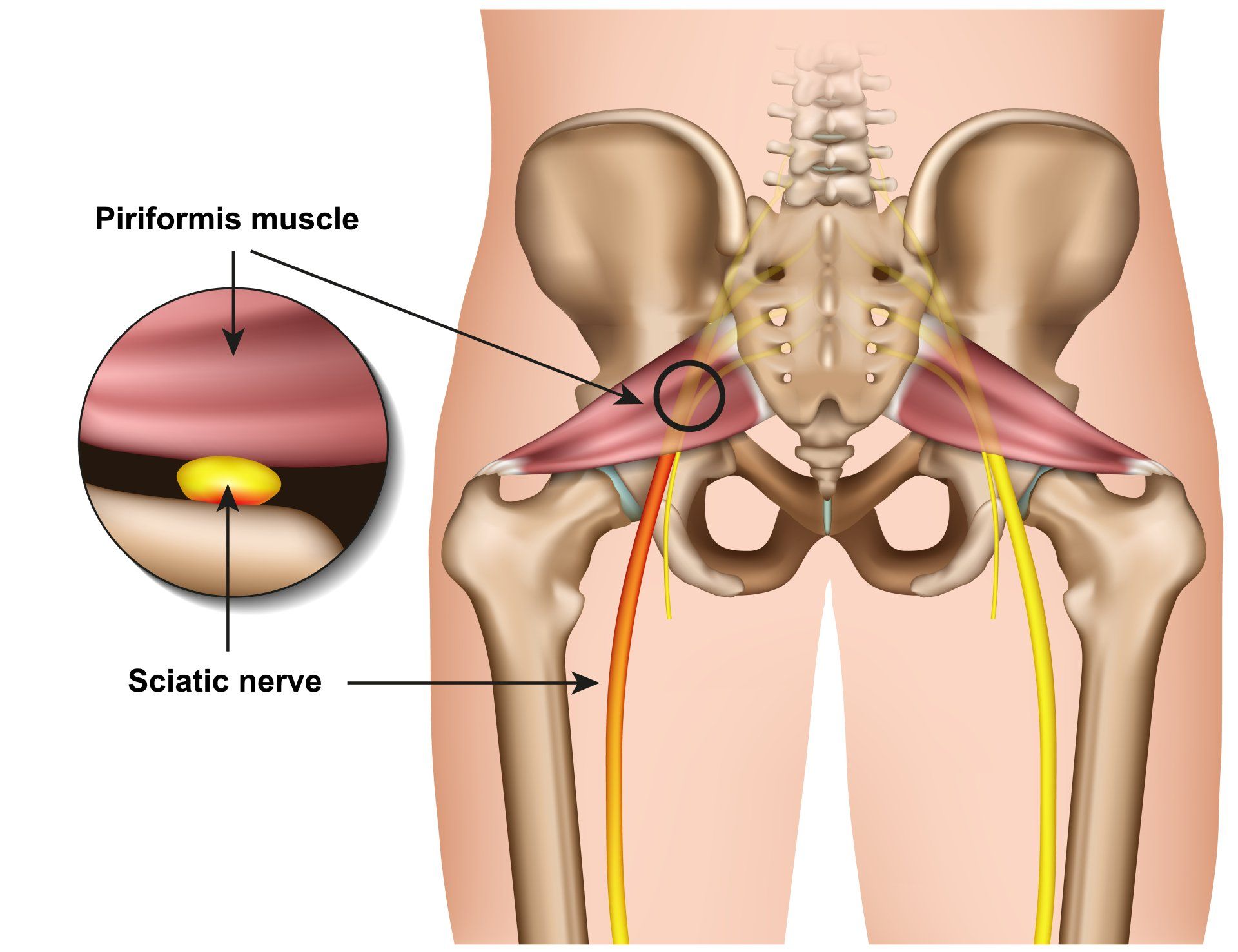 Piriformis Syndrome graphic