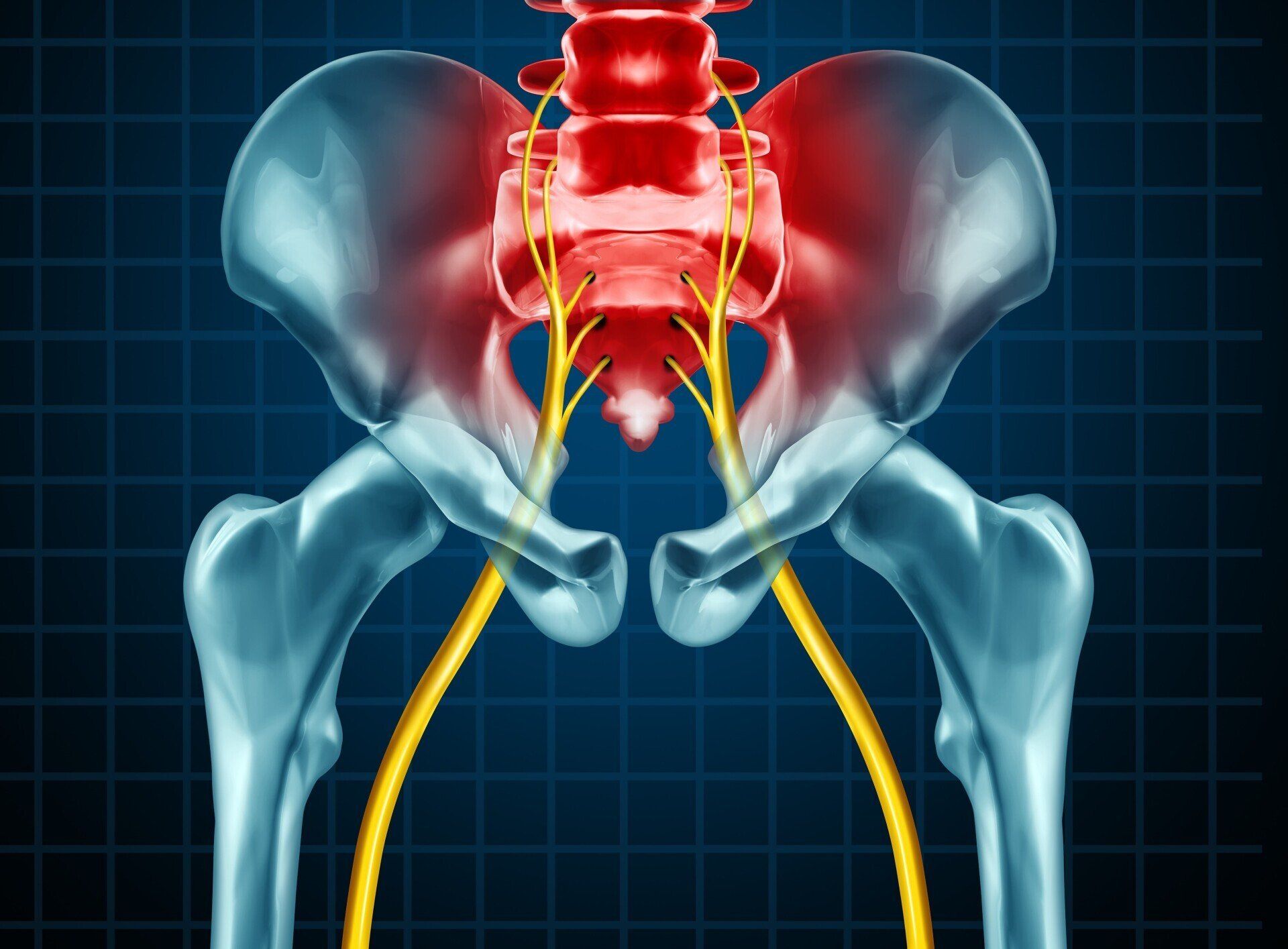 Graphic showing the location of the sciatic nerve