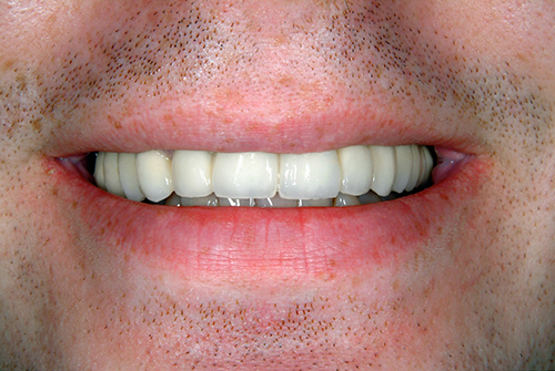 After Dental Implants