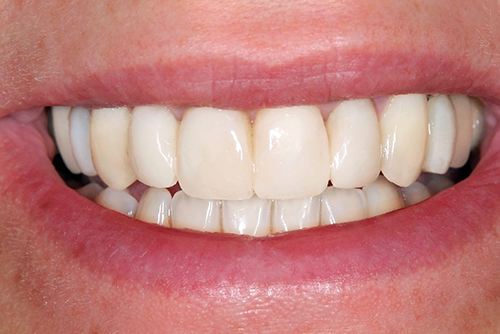 After Smile Makeover Treatment