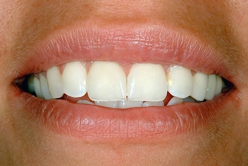 after porcelain veneers