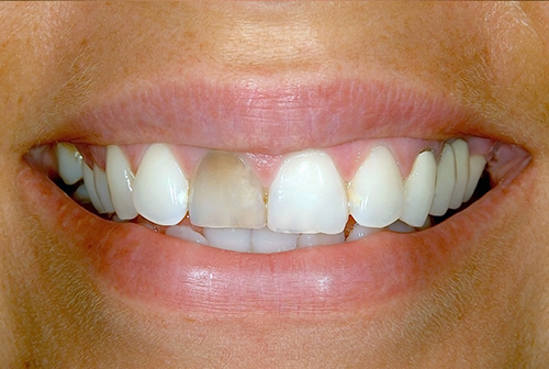 before porcelain veneers