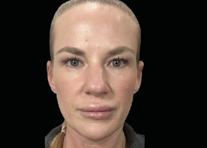 EMFACE TREATMENT