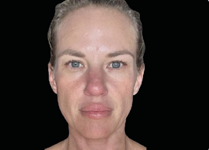 EMFACE TREATMENT