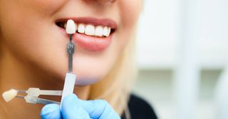 woman smile next to dental veneer