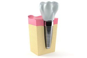 3D dental implant model