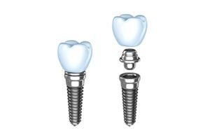 Illustration of Dental Implants
