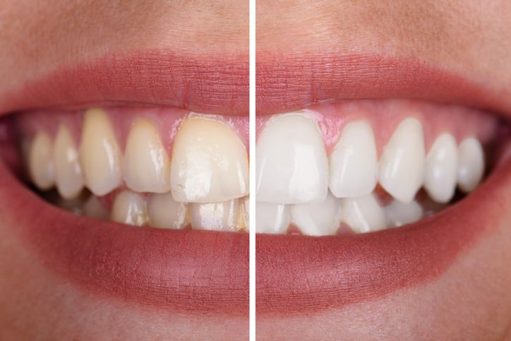 A comparison showing a smile before and after professional teeth whitening, displaying the difference in tooth shade.