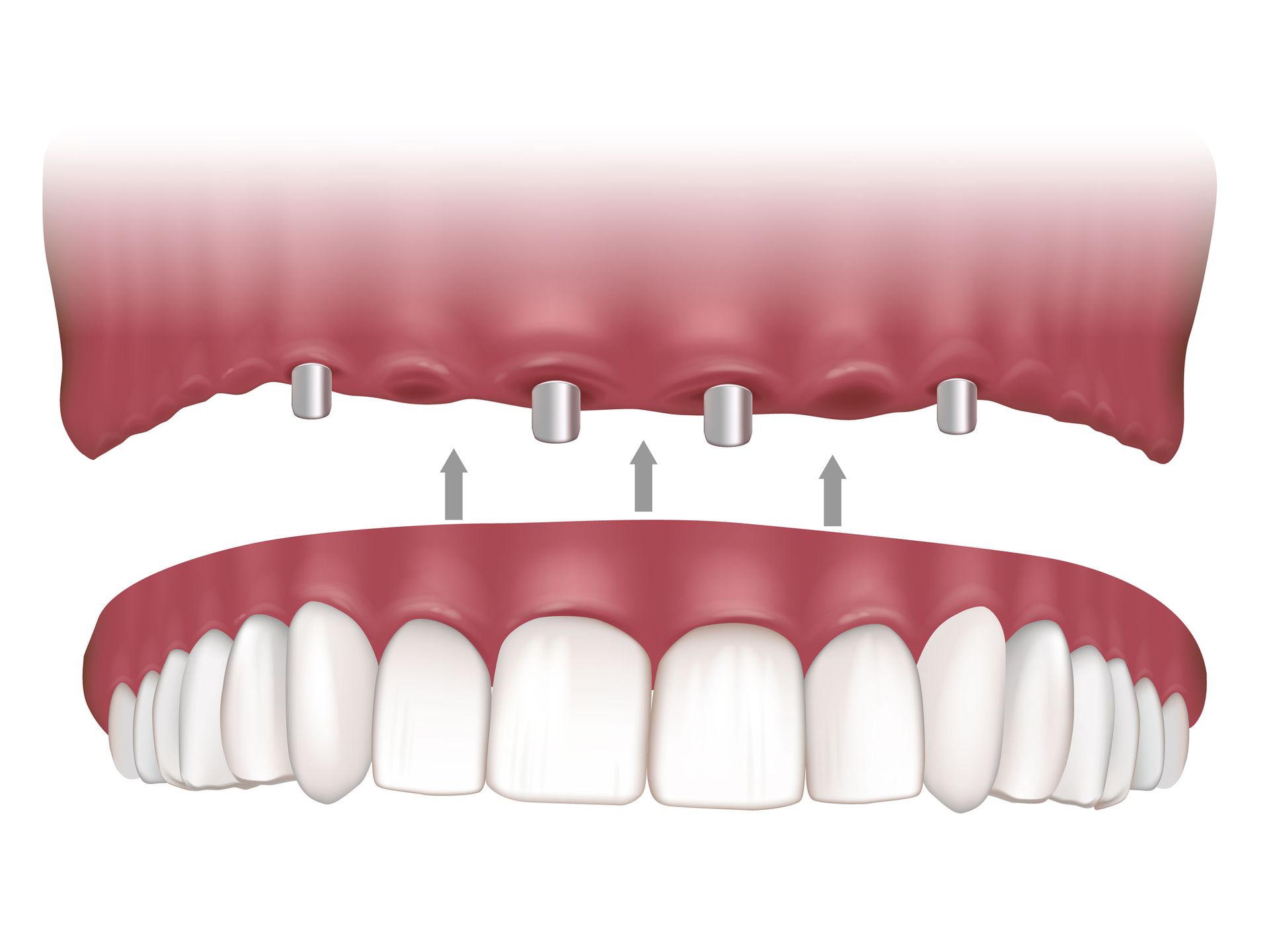 Overdentures Example