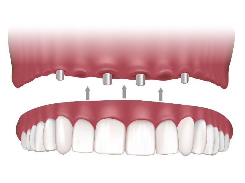 Overdentures Implant Supported