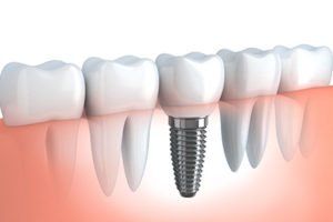 Illustration of Dental Implant