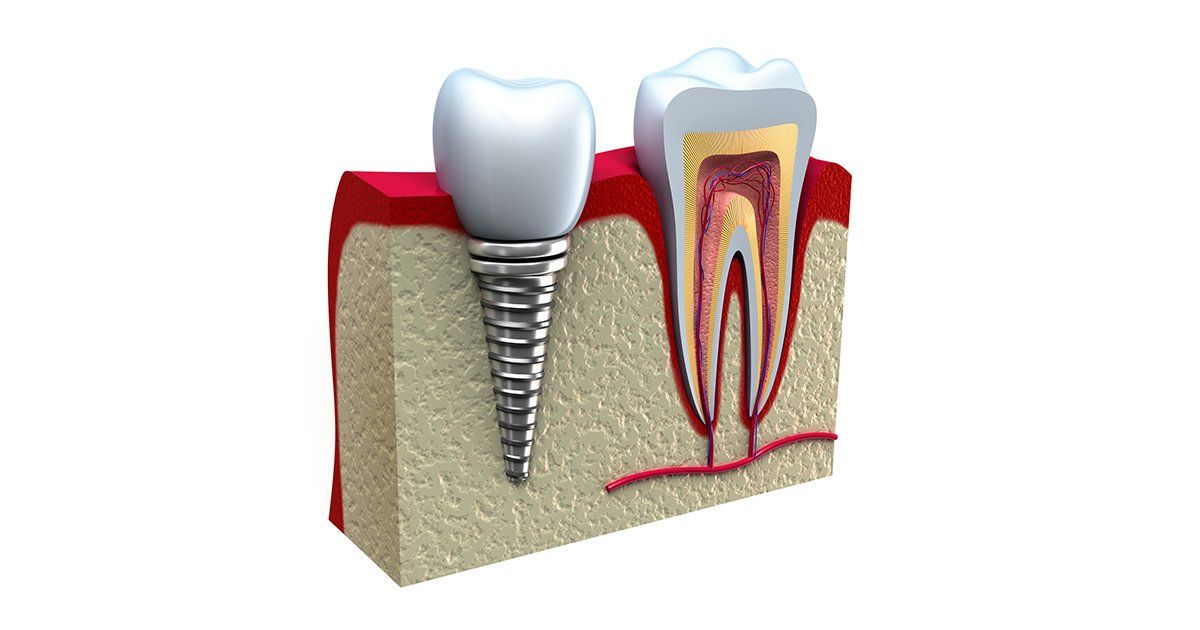 dental implants, Dentist in Ashburn VA