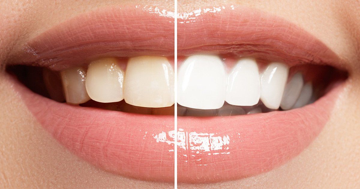 teeth whitening procedures, dentist in Ashburn VA