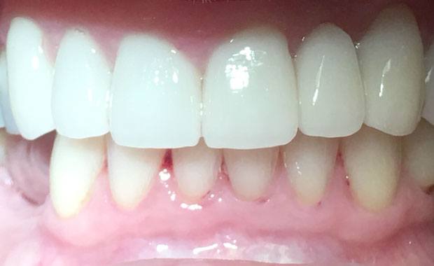 After Porcelain Bridges/Crowns and Veneers