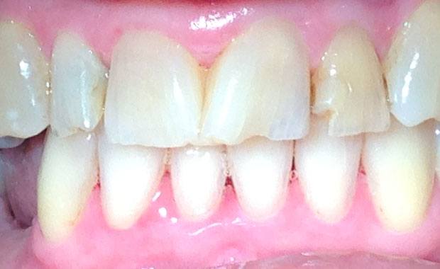 Before Porcelain Bridges/Crowns and Veneers