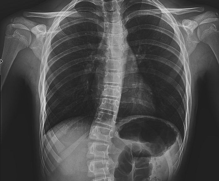 Escoliosis, ajuste quiropráctico para escoliosis, quiropráctico
