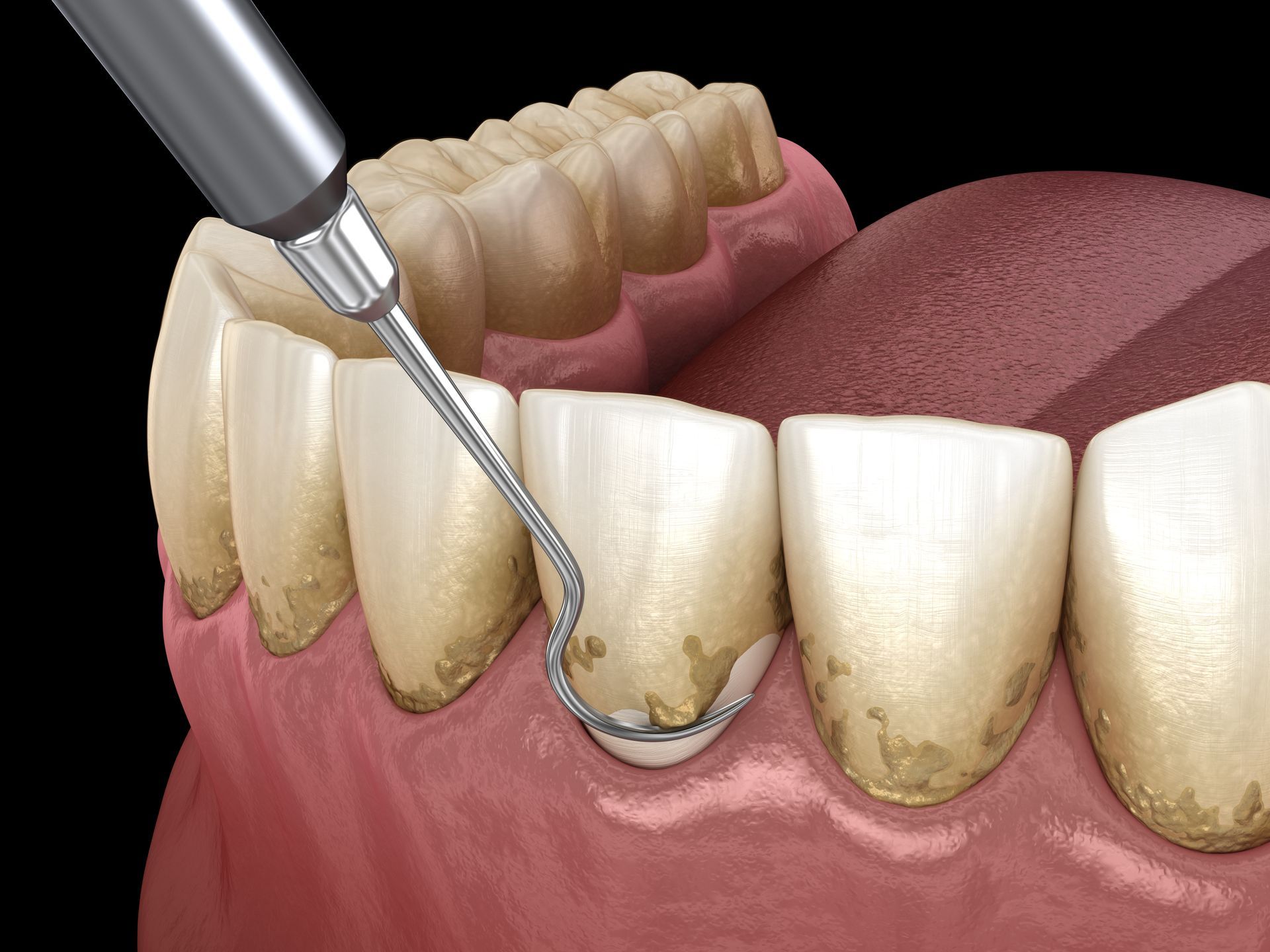 A close up of a person 's teeth being cleaned with a tool.