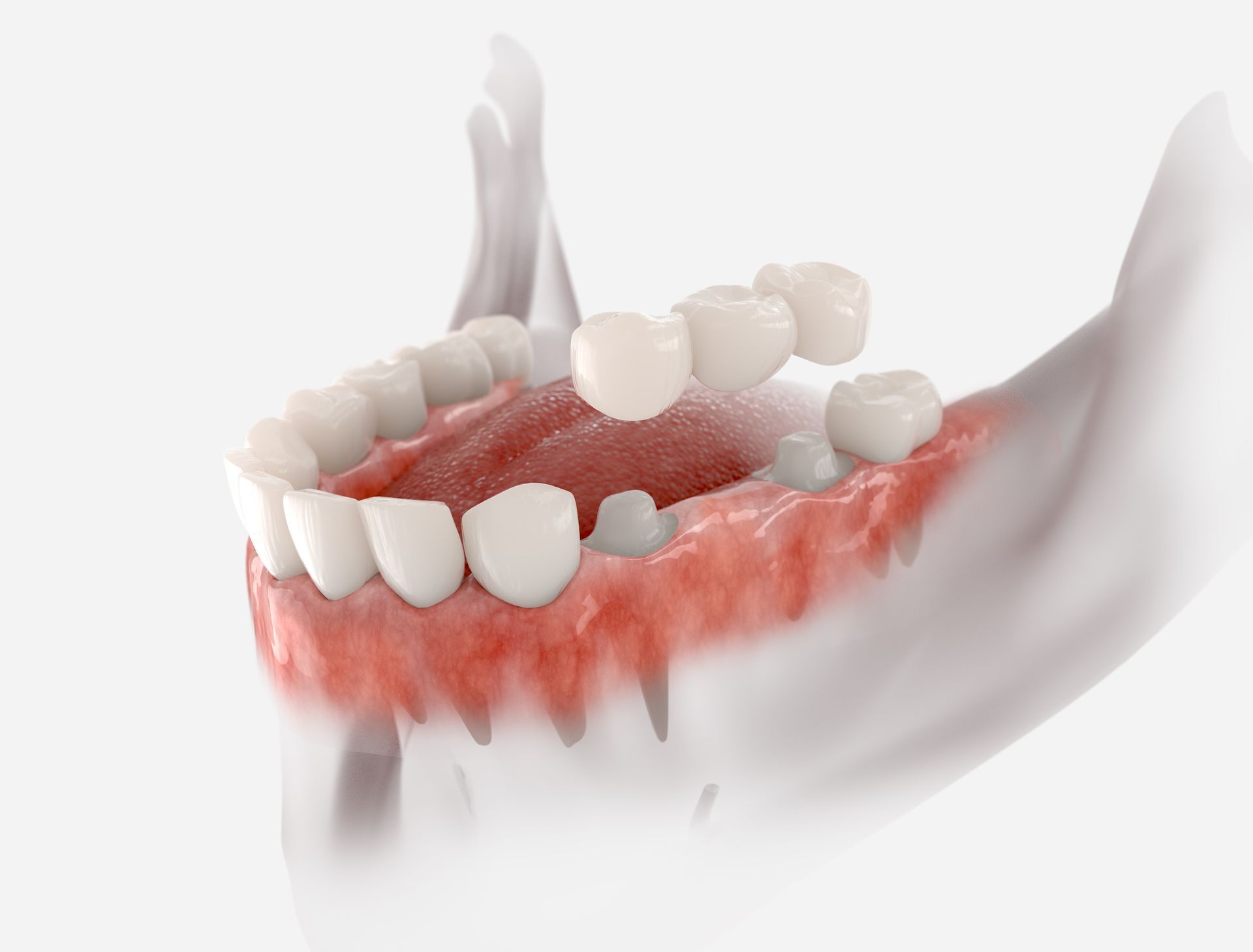 A 3d model of a person 's teeth with a dental bridge.