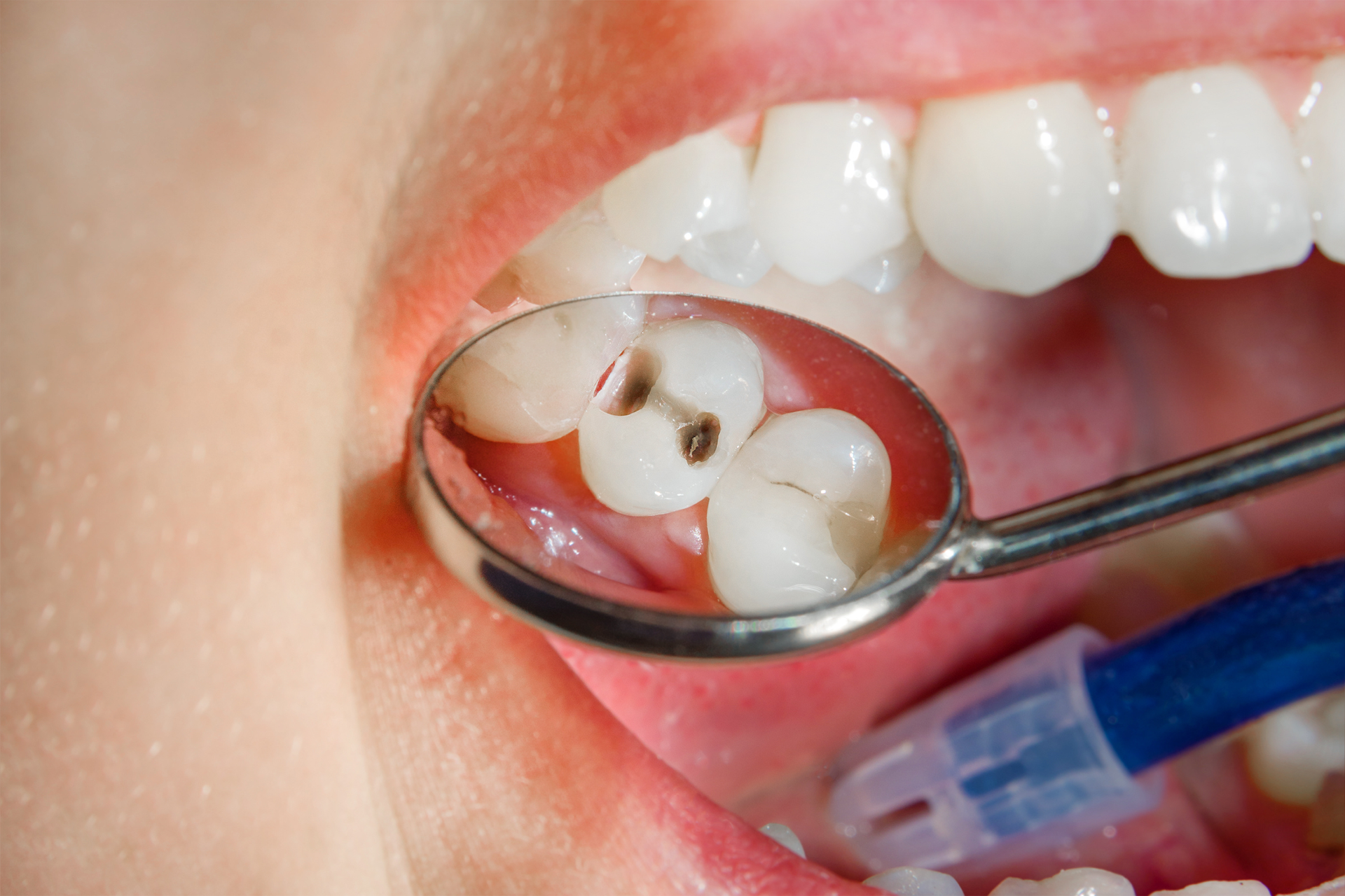 A person is getting their teeth examined by a dentist with a mirror.