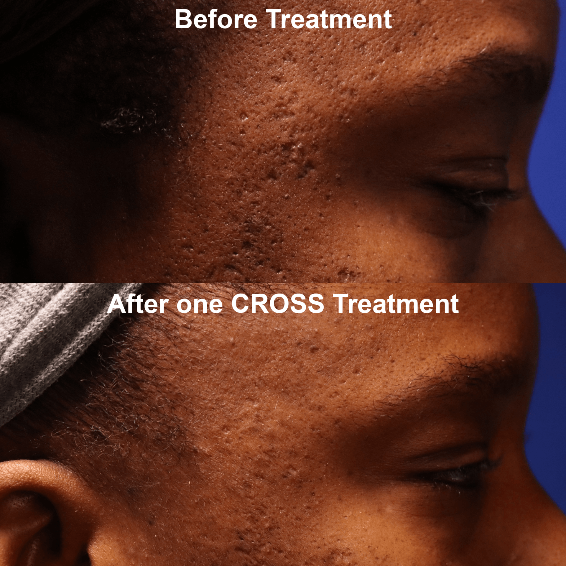 A before and after photo of a person 's face with acne.