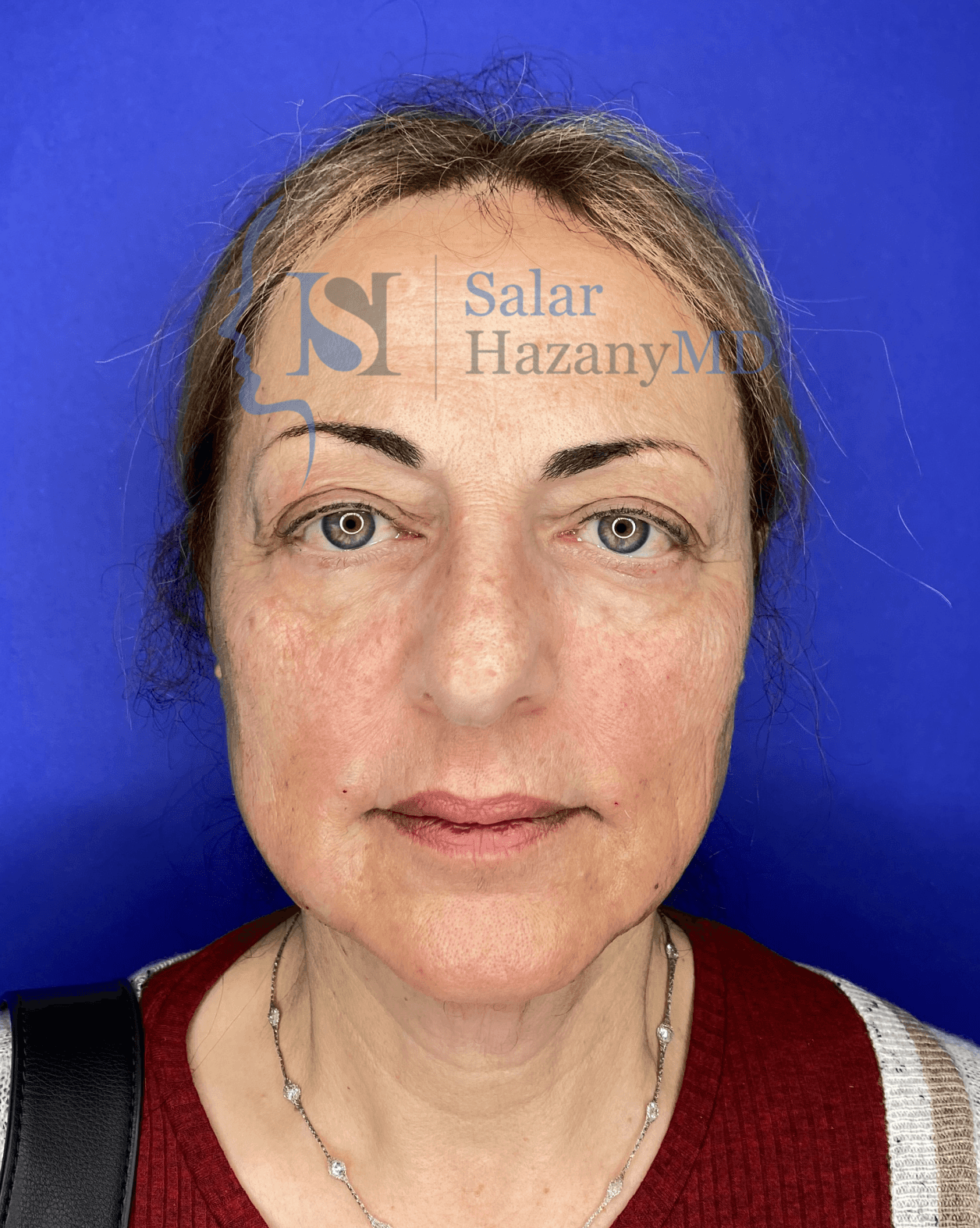 Searching for the best facelift surgeon in Los Angeles?