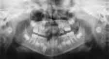 Blurry panoramic dental X-ray showing the full upper and lower teeth and jaw.