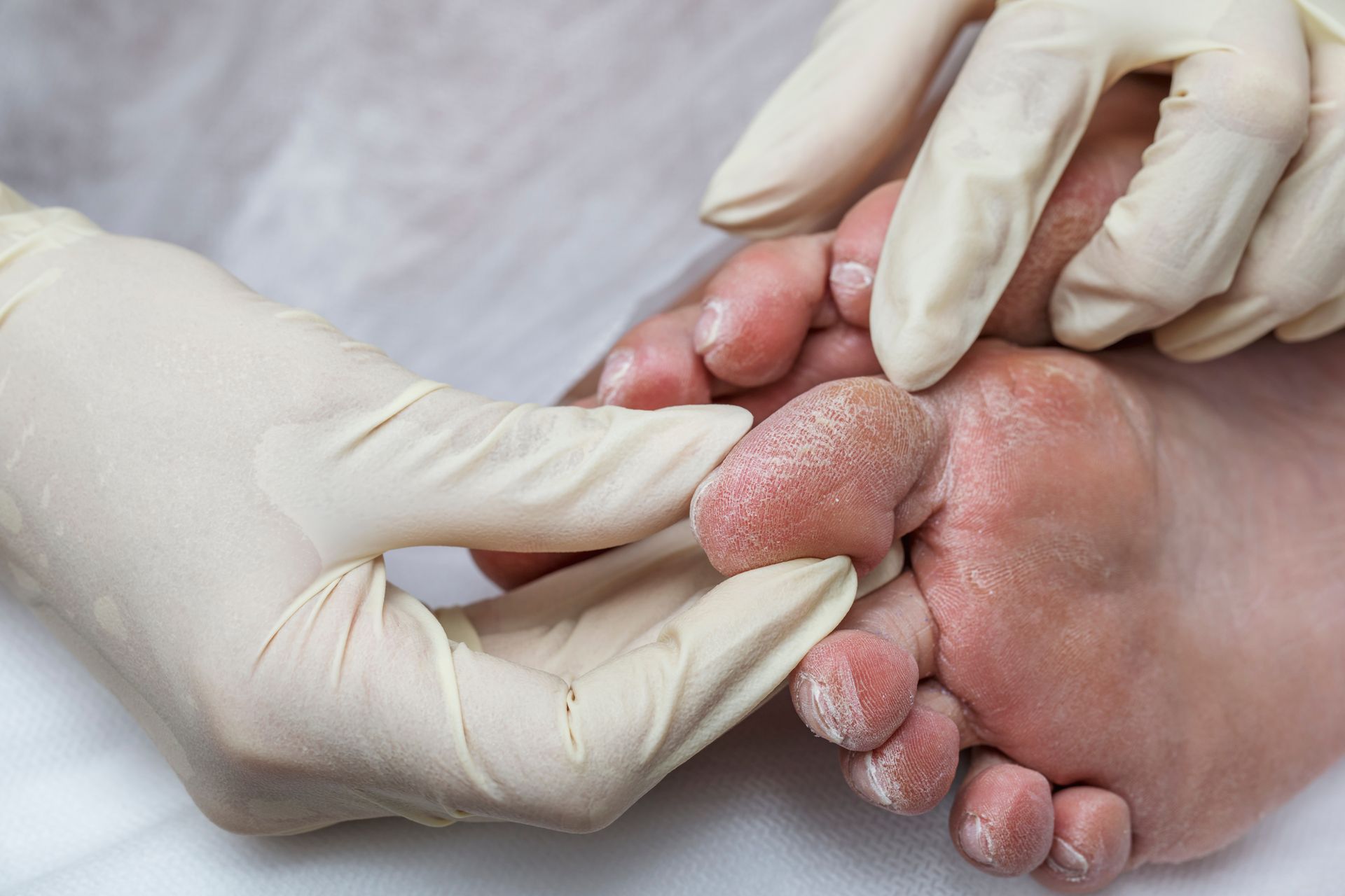 Gloved hands examining a foot with dry, cracked skin, possibly a medical examination.