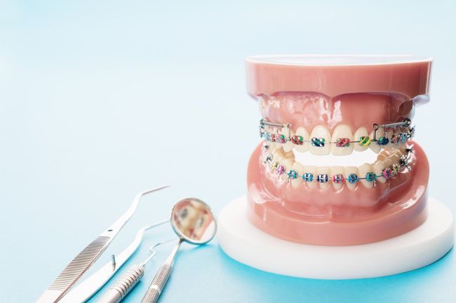 apparecchi ortodontici per bambini