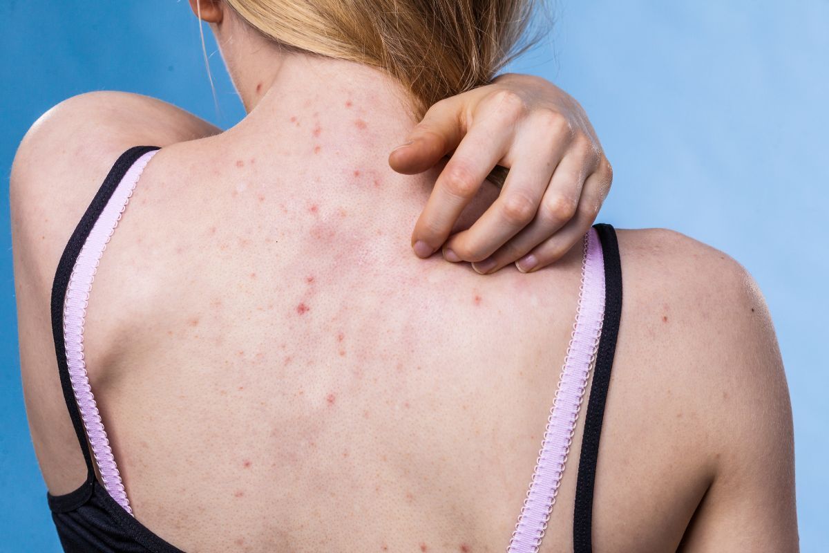 Skin breakouts treatment