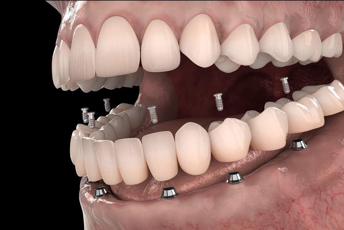 protesi dentali fisse
