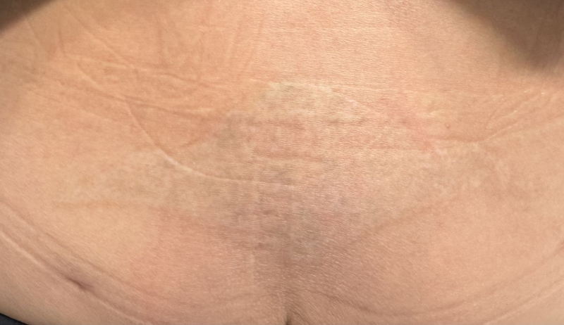 Close-up view of an area of skin on the lower back showing subtle texture and mild hyperpigmentation.