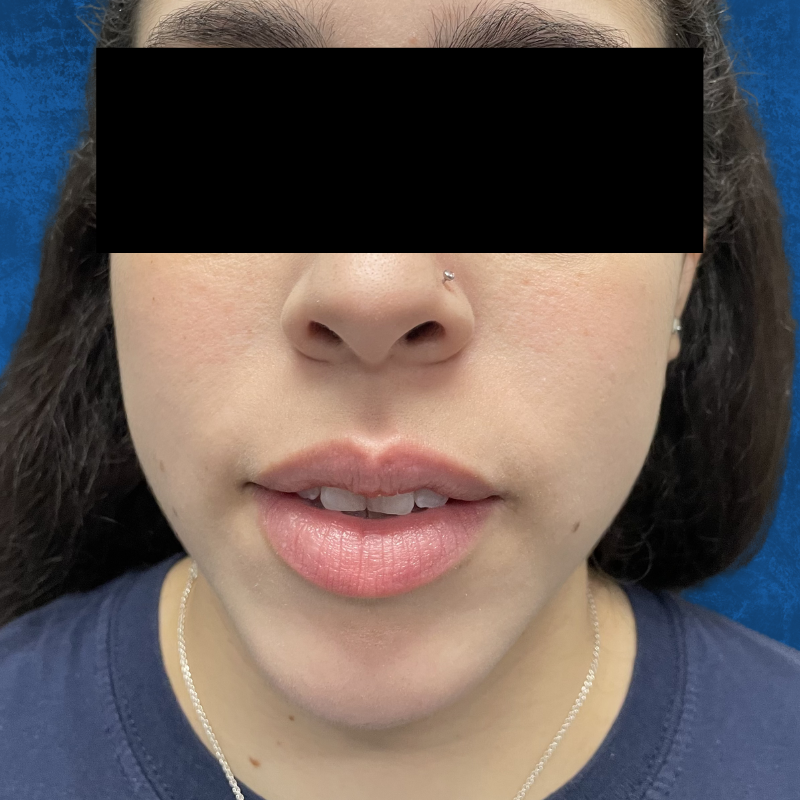 A person’s face, from the nose down to the chin, with a neutral expression against a plain, dark blue background.